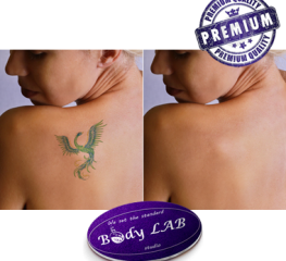 offer Премахване на татуировки и перманентен грим с лазер thumbnail